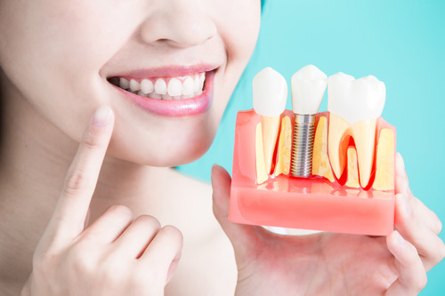 dental implants longevity