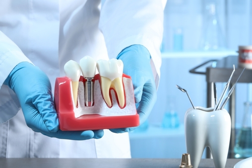 dental implant procedure