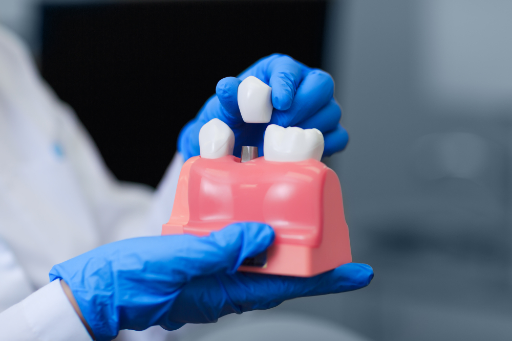 dental implants what are these